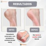 Spa Pés Espátula Bisturi Raspador goiva Calosidade elimina Pele Morta Calo calcanhar rachado - Imagem 3