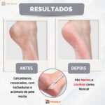 Kit 100 Bota Plástica Descartável + Raspador Espátula Bisturi Pés Podóloga elimina Pele Morta Calo - Imagem 4