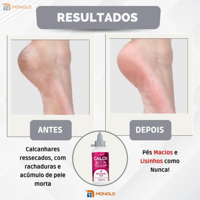 Kit Amaciante Calos Gel + Espátula Bisturi ref. 222 SPA Pés Podóloga Pedicure - Image 3